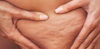 Cila argjilë është më efektive për celulitin?