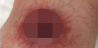 Autoritetet shëndetësore japin alarmin: Po përhapet një sëmundje që ha mishin…