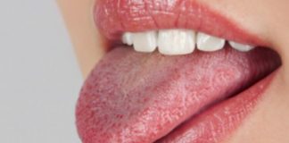 Këto janë 4 shenjat që paralajmërojnë kancerin në gjuhë