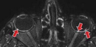 Ekspertët thirrje për të mos anashkaluar kontrollet, Covid-19 mund të çojë në humbje shikimi