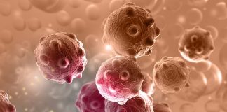 Studimi/ Tumoret lindin disa dekada, përpara se të shfaqen si sëmundje