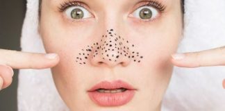 Ja metoda që duhet të përdorni për të hequr pikat e zeza