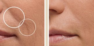 Disa mënyra për të trajtuar rrudhat rreth buzëve