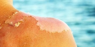 Çfarë i ndodh lëkurës kur digjemi nga dielli. Si të kujdeseni