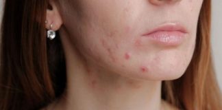 Si të shpëtoni nga aknet në mjekër