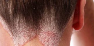 A është ngjitëse psoriaza?