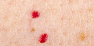 Shfaqja e nishaneve të kuq në trup, rastet kur janë shqetësuese