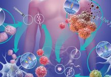 Nanoteknologjia dhe AI zbulojnë kancerin e prostatës në fazë të hershme?