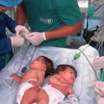 Histori mrekullie Krishtlindjesh në Peru/ Një spital realizon me sukses ndarjen e dy vajzave binjake siameze