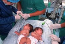 Histori mrekullie Krishtlindjesh në Peru/ Një spital realizon me sukses ndarjen e dy vajzave binjake siameze