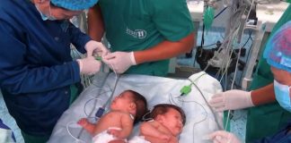 Histori mrekullie Krishtlindjesh në Peru/ Një spital realizon me sukses ndarjen e dy vajzave binjake siameze