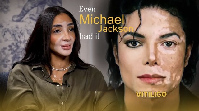 Publiku e keqkuptoi për vite   Modelja  Michael Jackson nuk e ndryshoi vetë lëkurën  tregon detaje për sëmundjen e tyre